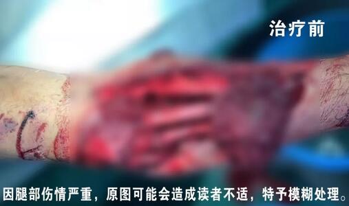 感謝安利醫(yī)院挽救了我的腿，沒有讓我落下殘疾……”