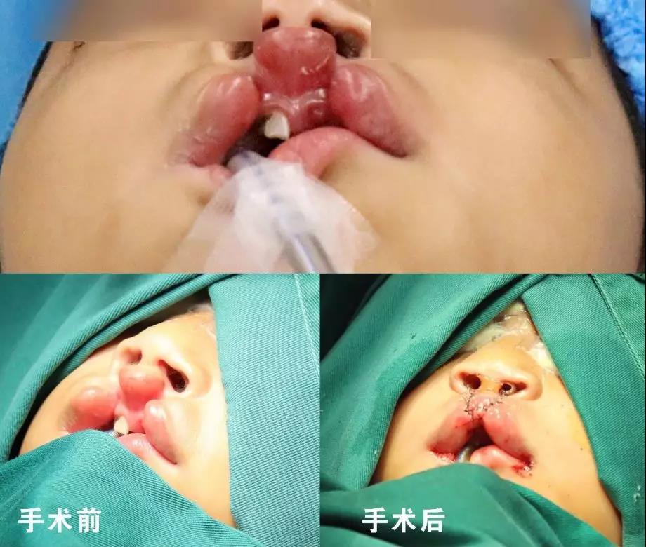 唇腭裂盡早治療消除孩子自卑心理，快樂(lè)成長(zhǎng)！