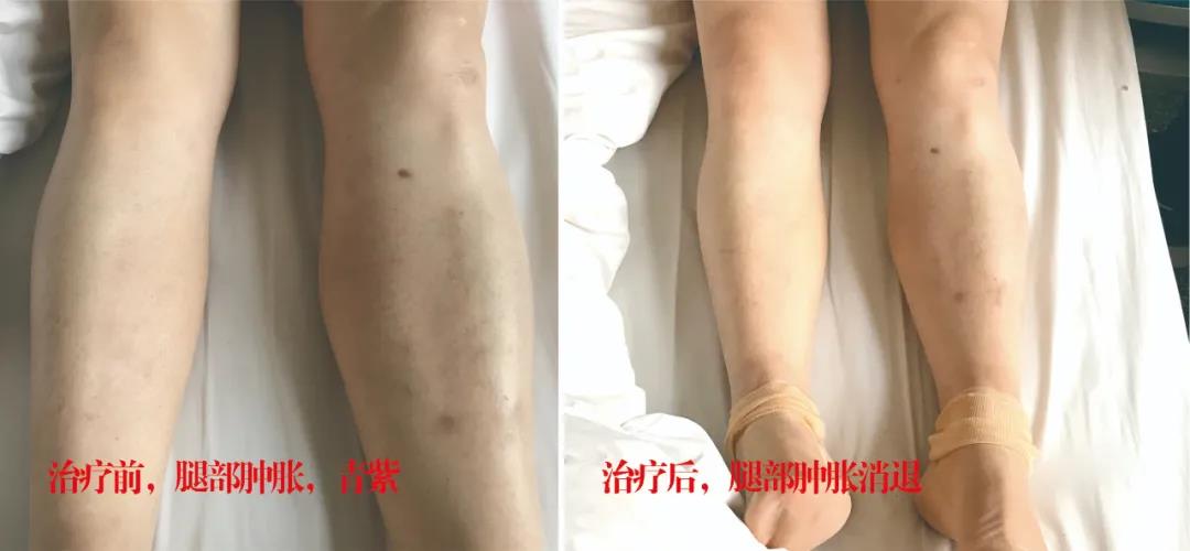 下肢靜脈血栓多年頑疾反復(fù)腫痛——疾病不容等待，早治療，早健康！