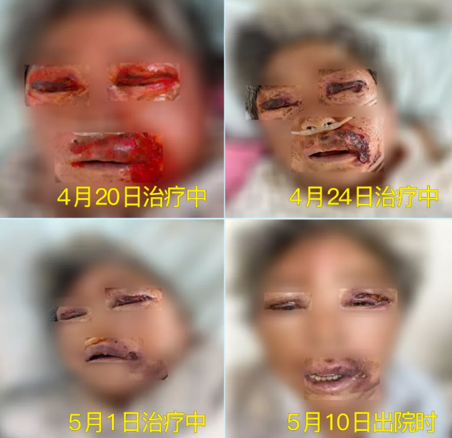 膿毒血癥（急性頜面部蜂窩組織炎）多學(xué)科聯(lián)合會(huì)診，幫助患者成功治愈！