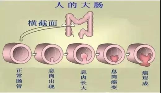 體檢發(fā)現(xiàn)腸息肉會(huì)癌變嗎？