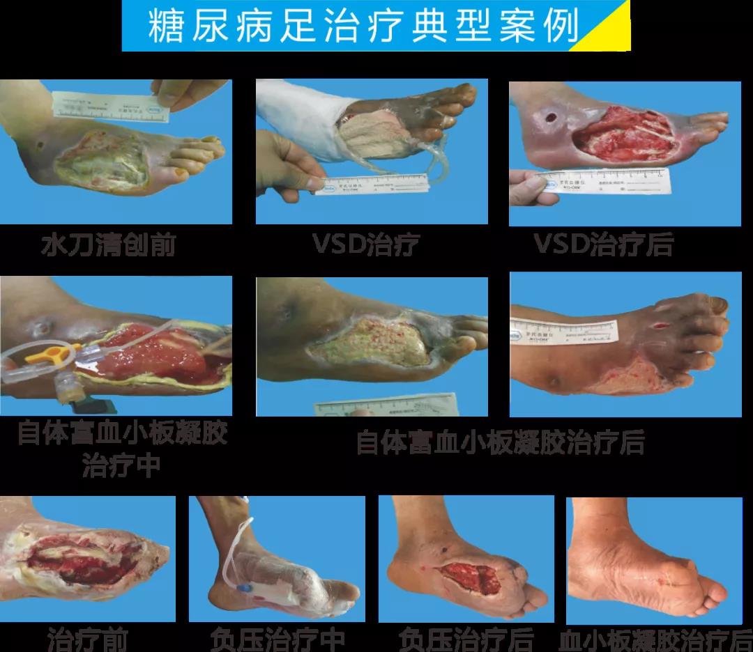 截肢、失明，甚至……，我們要做的是將糖尿病并發(fā)癥遏制在搖籃里！