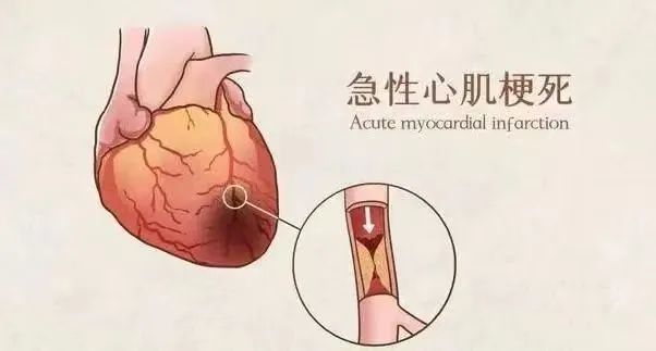 【保山安利醫(yī)院】11月20日“心梗救治日” 時(shí)間就是心肌，時(shí)間就是生命！