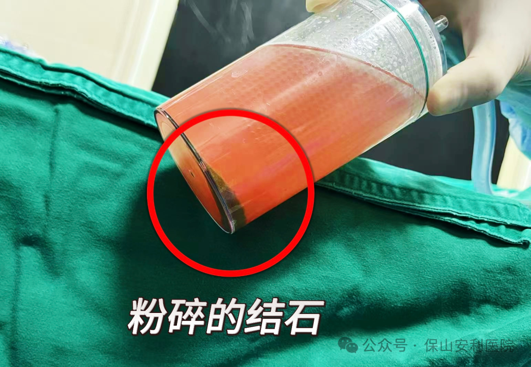 科普丨泌尿結(jié)石“克星”鈥激光碎石術(shù)，手術(shù)動圖揭秘全過程！